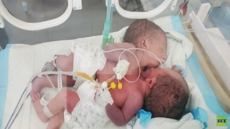 الحوثيون يطالبون الأمم المتحدة بإنقاذ حياة توأم سيامي في حالة حرجة