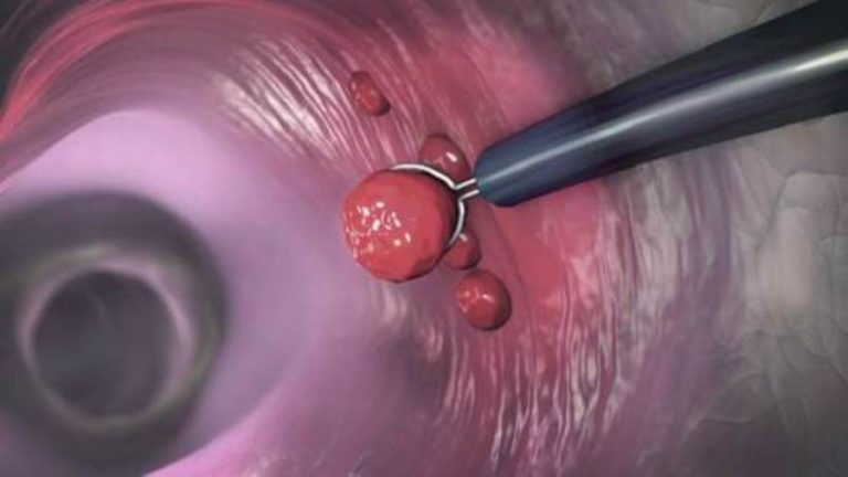 متى يكون الشعور بامتلاء البطن علامة تحذيرية لخطر الإصابة بسرطان الأمعاء؟